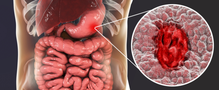 7-Day Meal Plan for Ulcerative Colitis: What to Eat During a Flare and in Remission